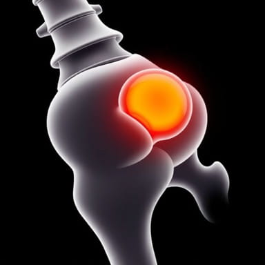 Tenosynovial Giant Cell Tumor