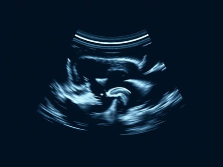 Thickened Uterine Lining Seen On Ultrasound