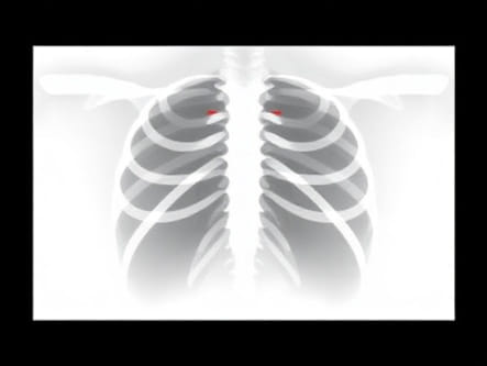 Pudendal Nerve Block X Ray