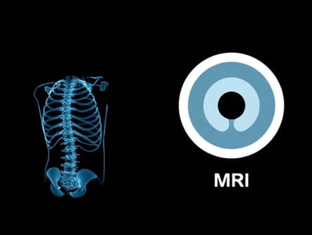 Xray Vs Mri For Back Pain