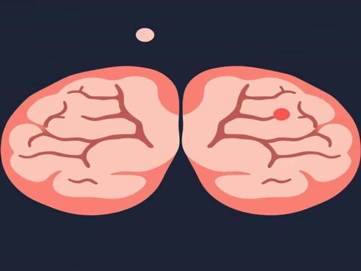 Neurological Complications Of Diphtheria
