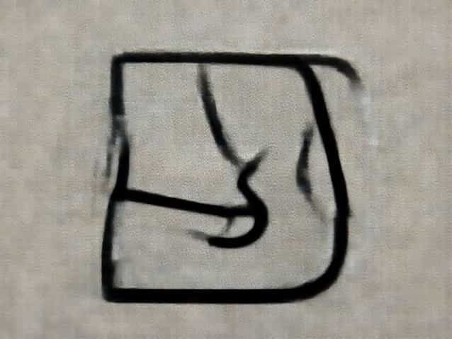 Right Side Abdominal Distension